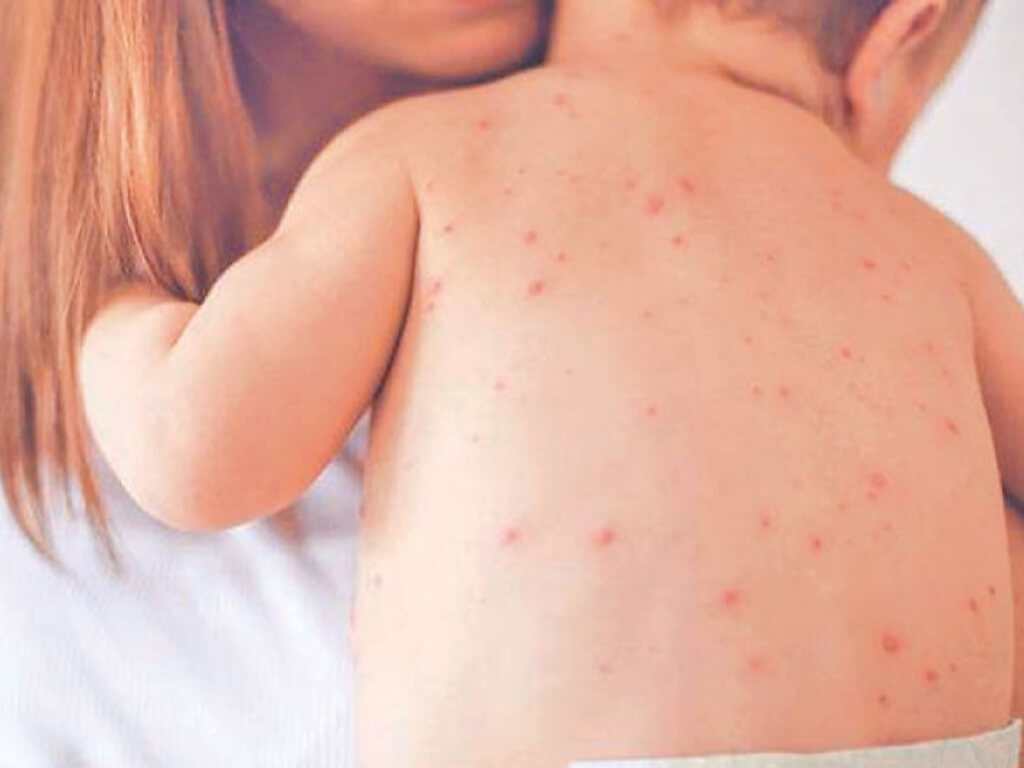 दुई महिनापछि ढोरपाटनमा दादुरा सङ्क्रमण रोकथाम