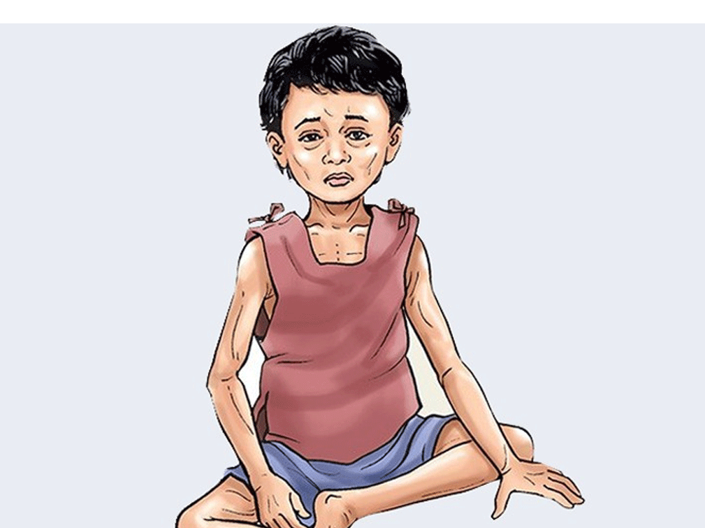मधेस प्रदेशमा १६ प्रतिशत बालबालिकामा कुपोषण